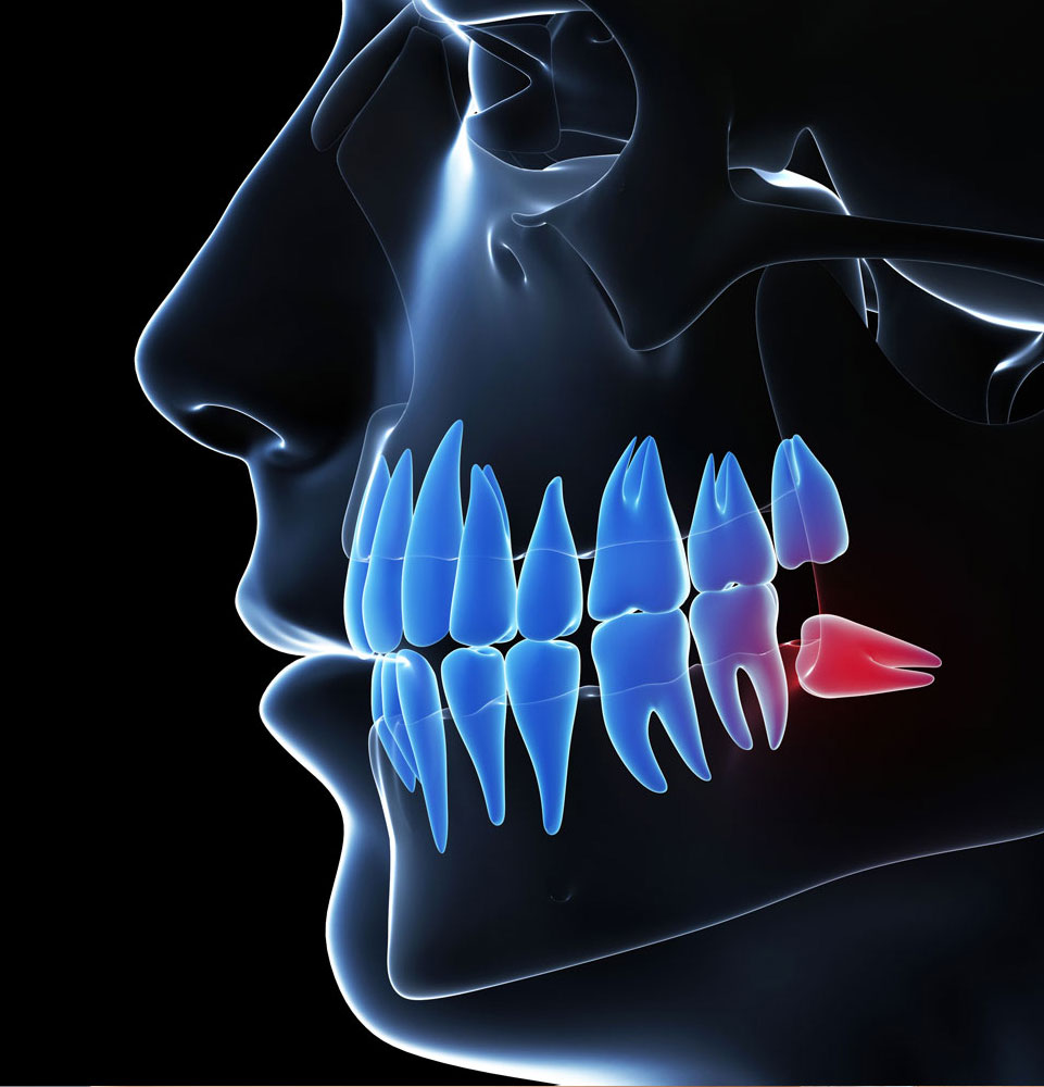 wisdom tooth 3d graphic